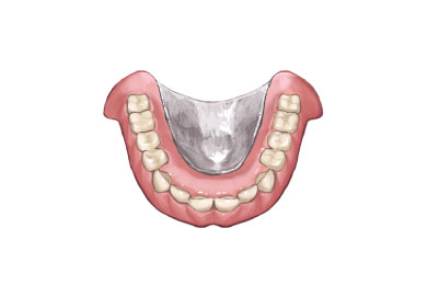 金属床義歯