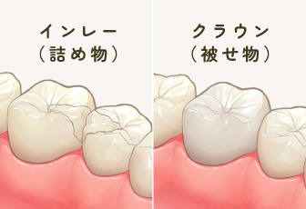 オールセラミック：インレー／クラウン