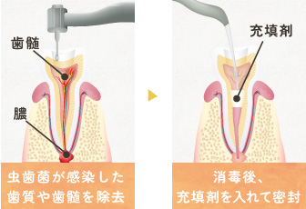 根管治療