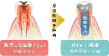 神経を残すためのMTAセメント治療