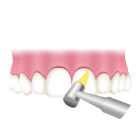 歯間や歯面をクリーニング