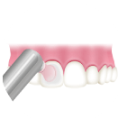 歯の表面をツルツルに仕上げ磨き